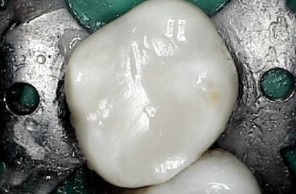 Flawless tooth with new tooth colored filling